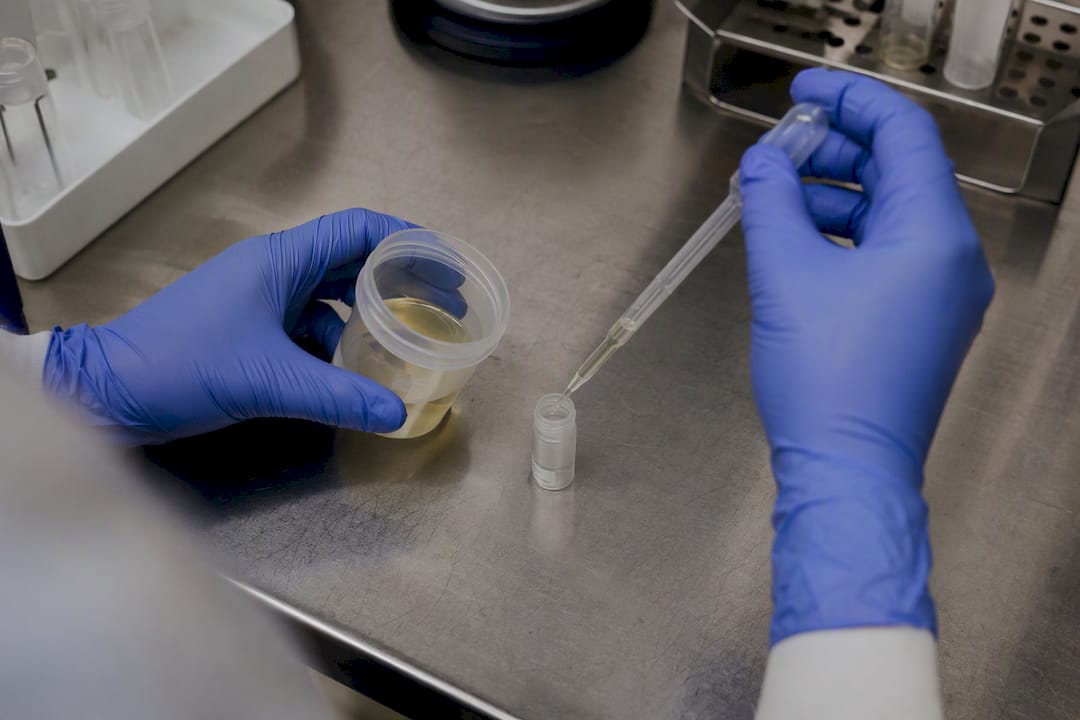 Hands pipetting urine sample into vial
