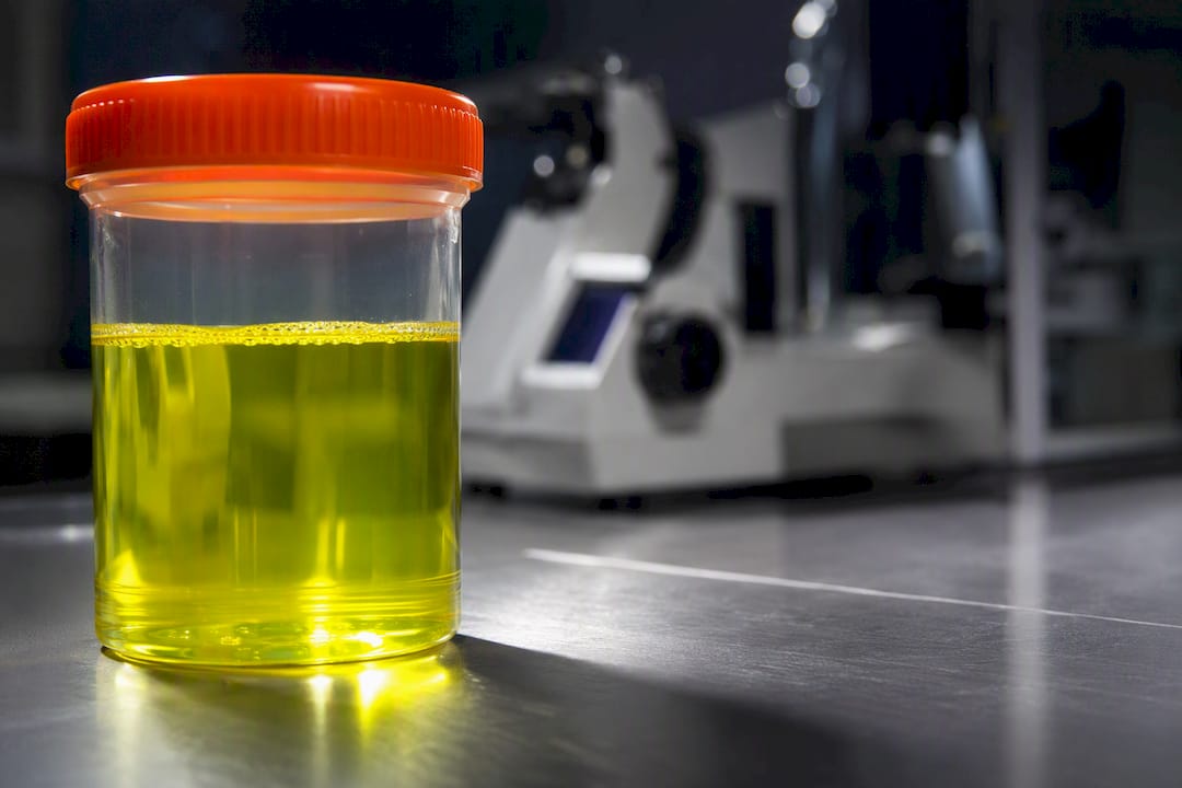Neon yellow urine sample in laboratory vial